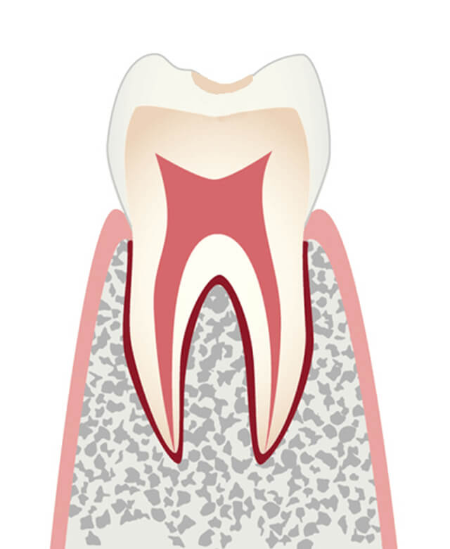 ごく初期のむし歯