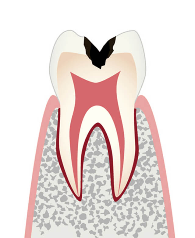 歯の内部（象牙質）まで進行したむし歯
