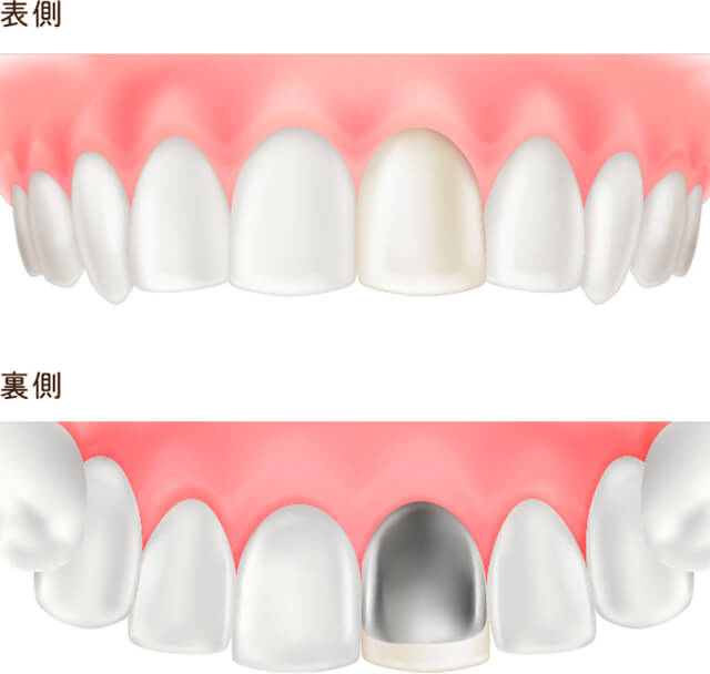 硬質レジン前装冠
