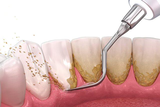 歯石をスケーラーで除去しているイラスト